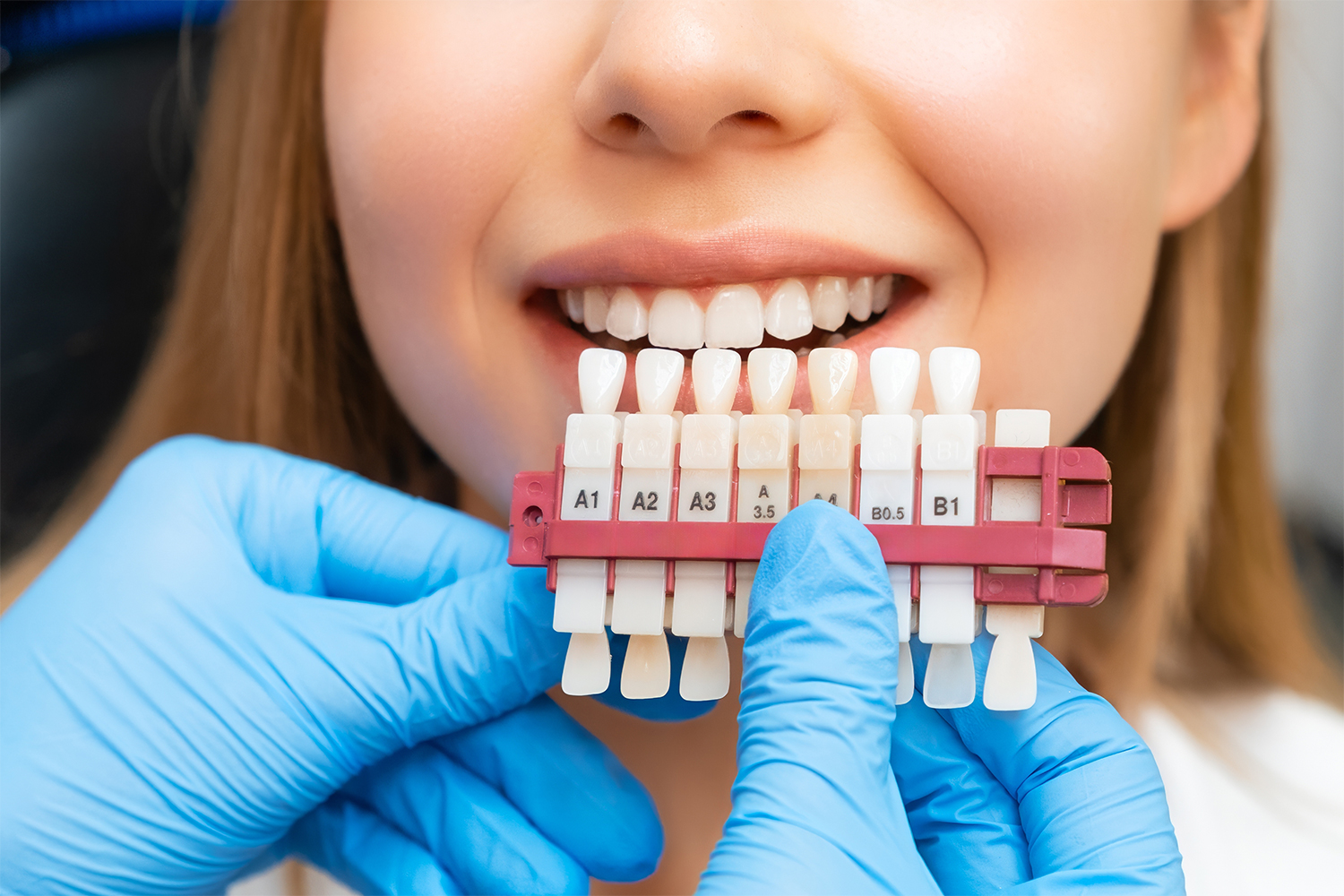Dental Veneers img 2