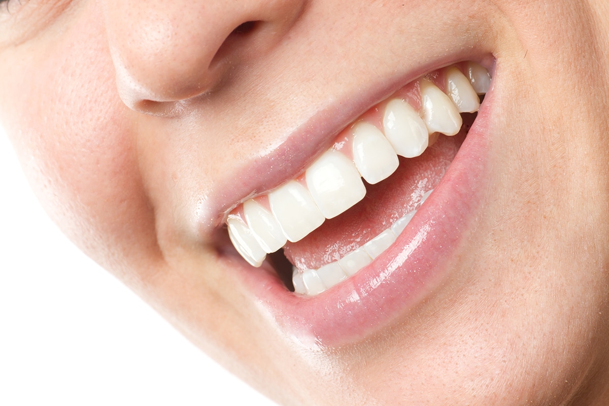 Are Veneers Permanent? What You Need to Know